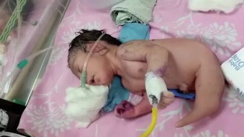 Doctors stunned after a baby is born with a mermaid like tail instead of legs