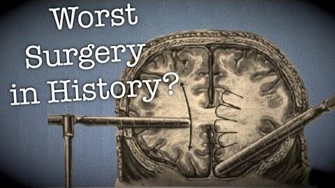 The Horrible Aspects of Science: The Lobotomy, the worst surgery in history?