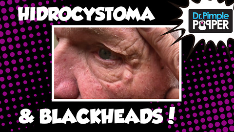 Hidrocystoma with some bonus Blackheads