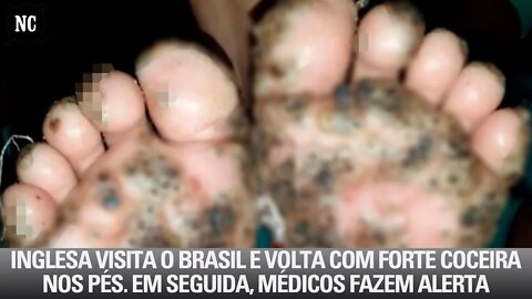 Inglesa visita o Brasil e volta com forte coceira nos pés. Em seguida, médicos fazem alerta