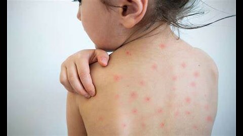 Measles V MMR
