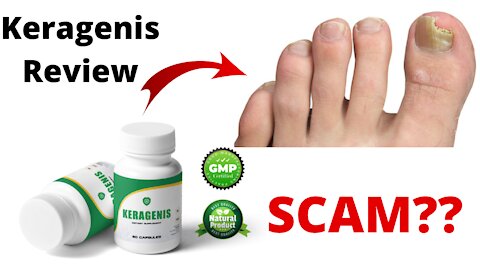 Keragenis Review - Toenail Fungus Removal