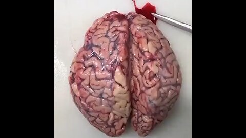 BloodClots in the brain!
