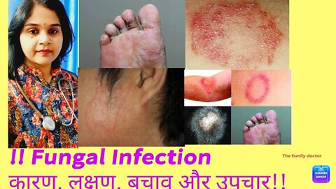 Fungal infection कारण, लक्षण और होम्योपैथिक उपचार