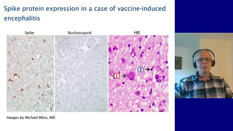 Alternate mechanisms of mRNA vaccine toxicity: which one is the main culprit?