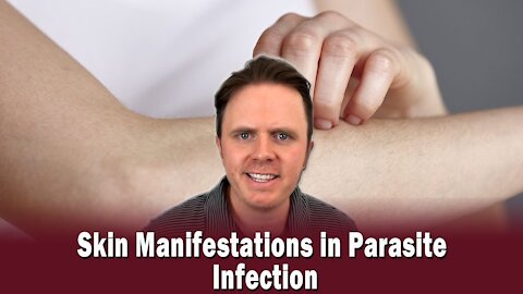 Skin Manifestations in Parasite Infection