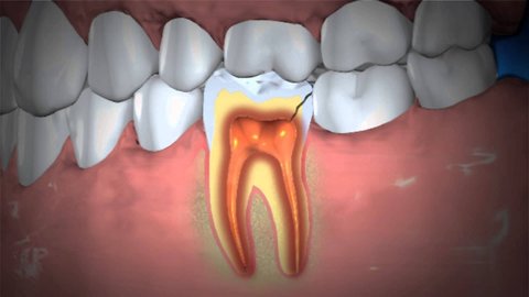 Natural cures: How to treat an abscessed tooth