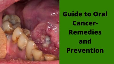 Dental Care: Guide to Oral Cancer--Remedies and Prevention