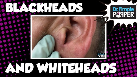 The Good, the Bad, the Great Blackheads & Whiteheads