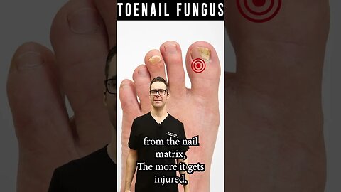 How to Know If Toenail Fungus is Dying? [How Fast Do Nails Grow?]