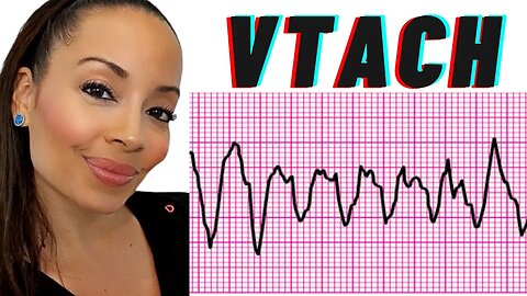 Ventricular Tachycardia (VTACH) ECG Interpretation, Causes, Treatment, Nursing NCLEX Review
