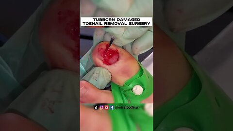 STUBBORN DAMAGED TOENAIL REMOVAL SURGERY 2023 BY FAMOUS PODIATRIST MISS FOOT FIXER