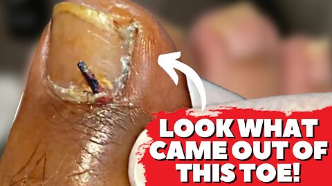 DEEP Thorn Removal From Toe!! 😨 (Home Remedy To Remove Foreign Body From Toe)