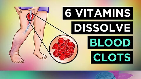 6 Vitamins To DISSOLVE Your BLOOD CLOTS