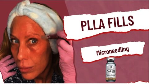 PLLA Fills *Wrinkle Free* Microneedling for Smooth Skin & Collagen - SASSY10 10% @ Glamderma