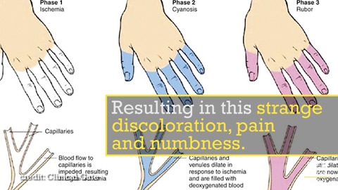 Raynaud's Disease Is A Finger Numbing Mystery
