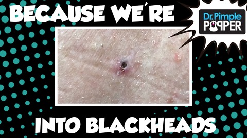 Because we're into Blackheads...