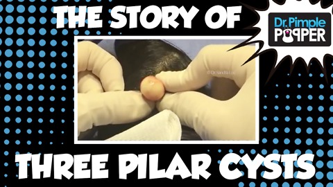 The Story of 3 Pilar Cysts: Part 1 of 2