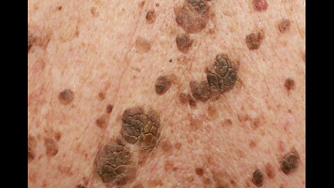 Keratosis is a Skin Condition Caused By Parasites-Here is PROOF!