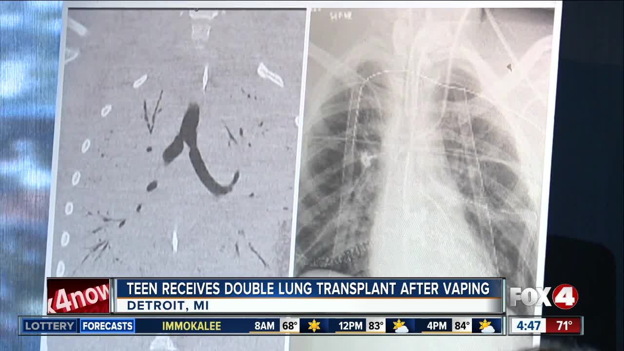 Teen gets double lung transplant after vaping