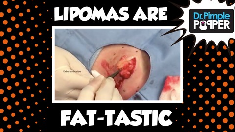 Who Thinks Lipomas are FAT-tastic?