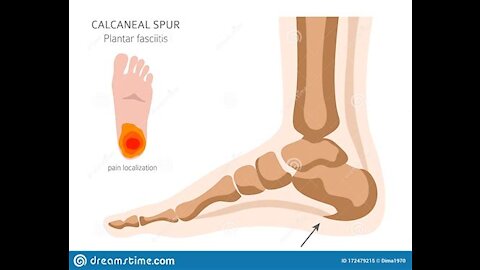 Plantar Facilities Correctives part 3