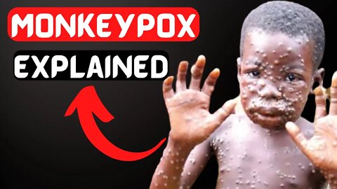 Monkeypox: Should you be worried?