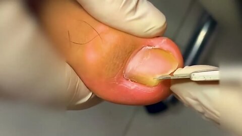 Manicure Unclogging the toenail Solve your problem #14 | 2022 Video