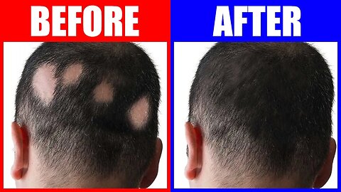 3 Trace Minerals to Reverse Alopecia (Pattern Hair Loss)