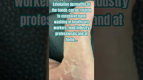 Terrible hand eczema #pov