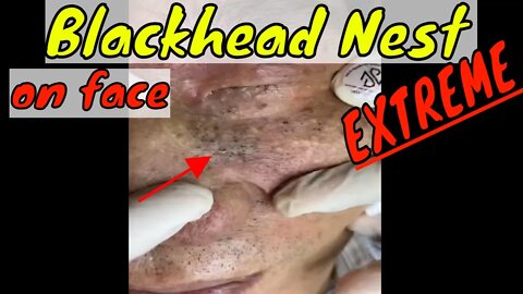 Extreme blackhead nest on face 😳 #blackheadremoval #blackhead #blackheads #fyp #fypage #fypviral