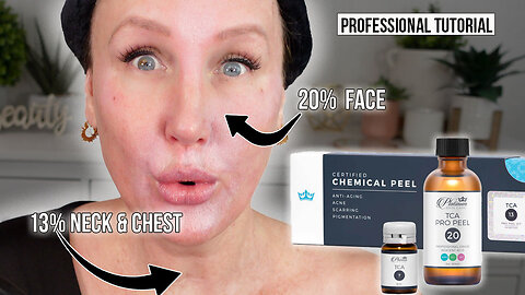 TCA Peel Tutorial // Face + Neck + Chest + Shoulders