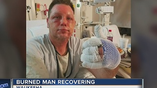 Waukesha man severely burned after grease fire