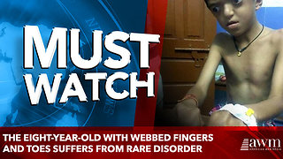 The eight-year-old with webbed fingers and toes suffers from rare disorder