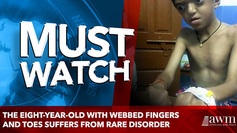 The eight-year-old with webbed fingers and toes suffers from rare disorder