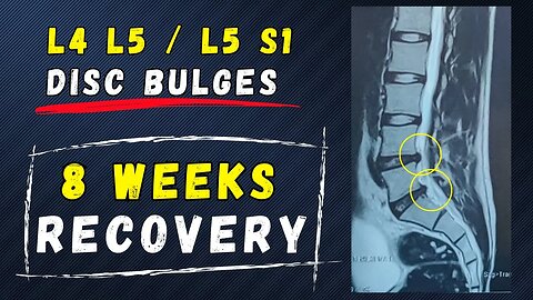 L4 L5 L5 S1 Lumbar Disc bulge recovery at home