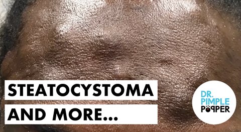 Forehead & More, Steatocystomas
