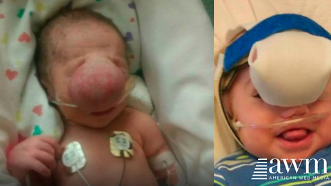 Baby Born With Sac Covering His Face Looks So Different After Surgery To Remove It