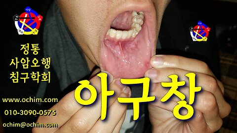 아구창 치료 방법 - 비과학적 양의학 203 - 사암침, 사암침법, 정통사암침