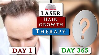 Laser HAIR GROWTH therapy REVIEW || iRestore device BEFORE & AFTER