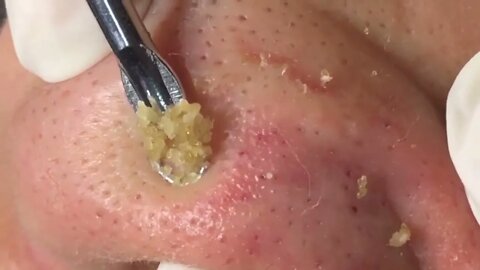 Nose blackhead extraction