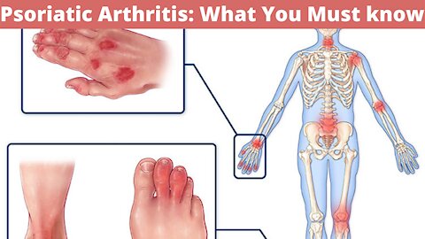 Psoriatic Arthritis - Everything You Want To Know About Psoriatic Arthritis