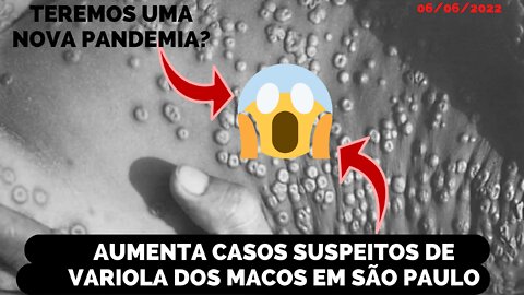 AUMENTA PARA SETE O NÚMERO DE CASOS SUSPEITOS DE VARIOLA DOS MACACOS EM SÃO PAULO