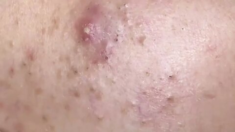 Removal / extraction of blackheads and pimples. Satisfying videos to relax!