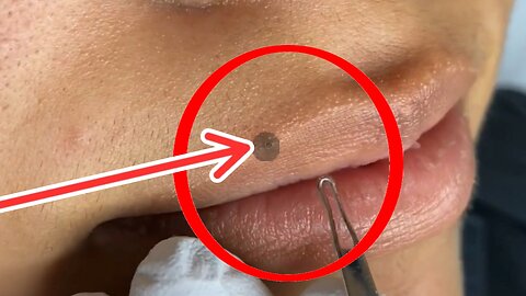 blackheads in lips | blackheads lips ears |