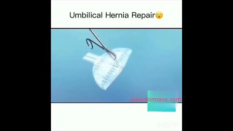 umbilical hernia repair