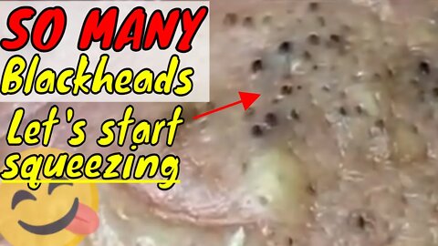 So many blackheads 😳 let's start squeezing 😋 #blackheadremoval #blackhead #blackheads #satisfying