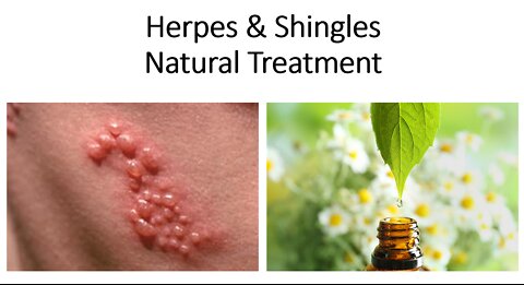 Herpes & Shingles Natural Treatment