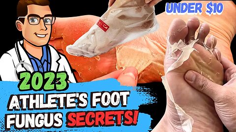 BEST Athlete's Foot Fungus Treatments [HOME Remedies + 3 BIG SECRETS]