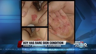 Tucson family raising awareness for son's rare, painful skin condition